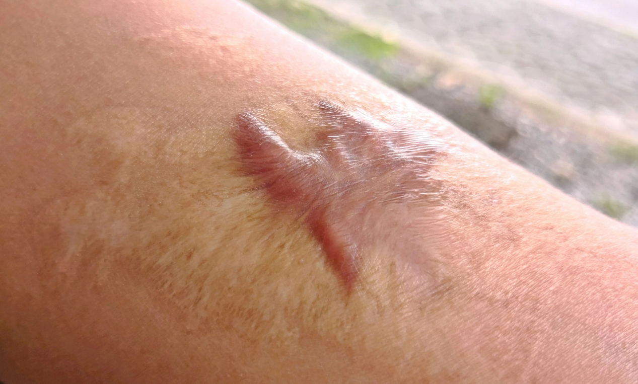 Шрамы и рубцы 6.png