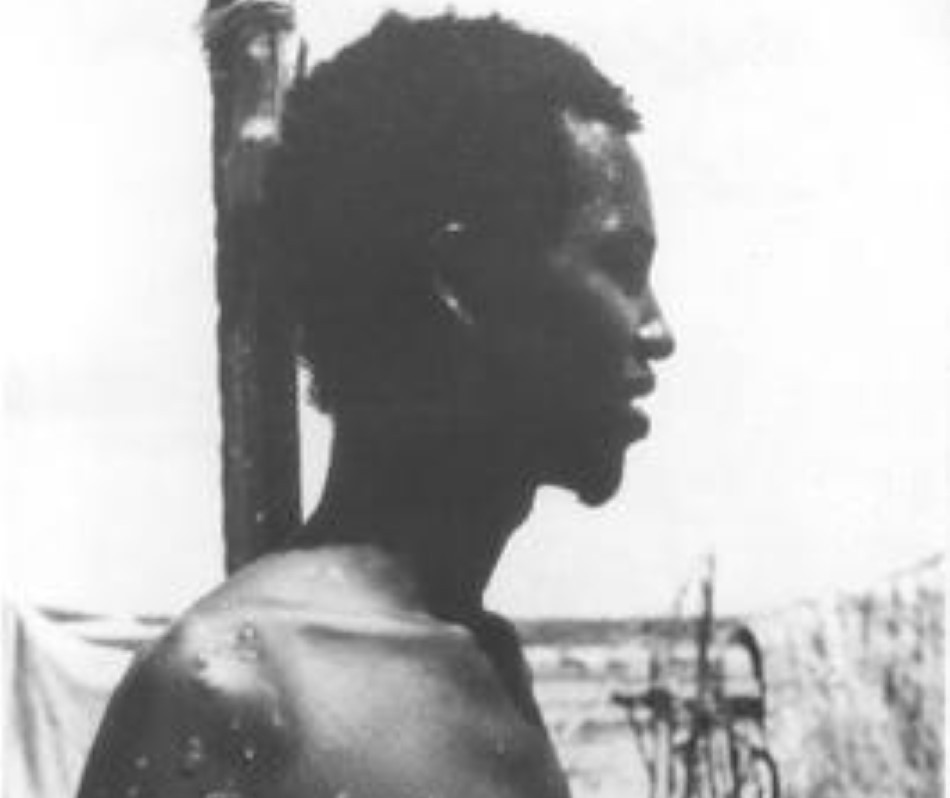 9-Мао Моаллим - последний человек заразившийся оспой естественным путем.jpg