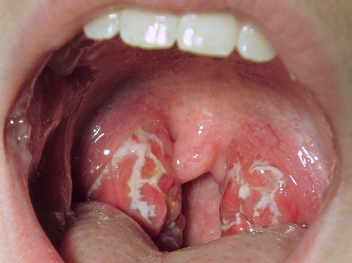 6-Горло при гнойной ангине.jpg