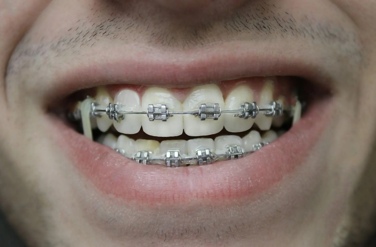 Зубы брекеты