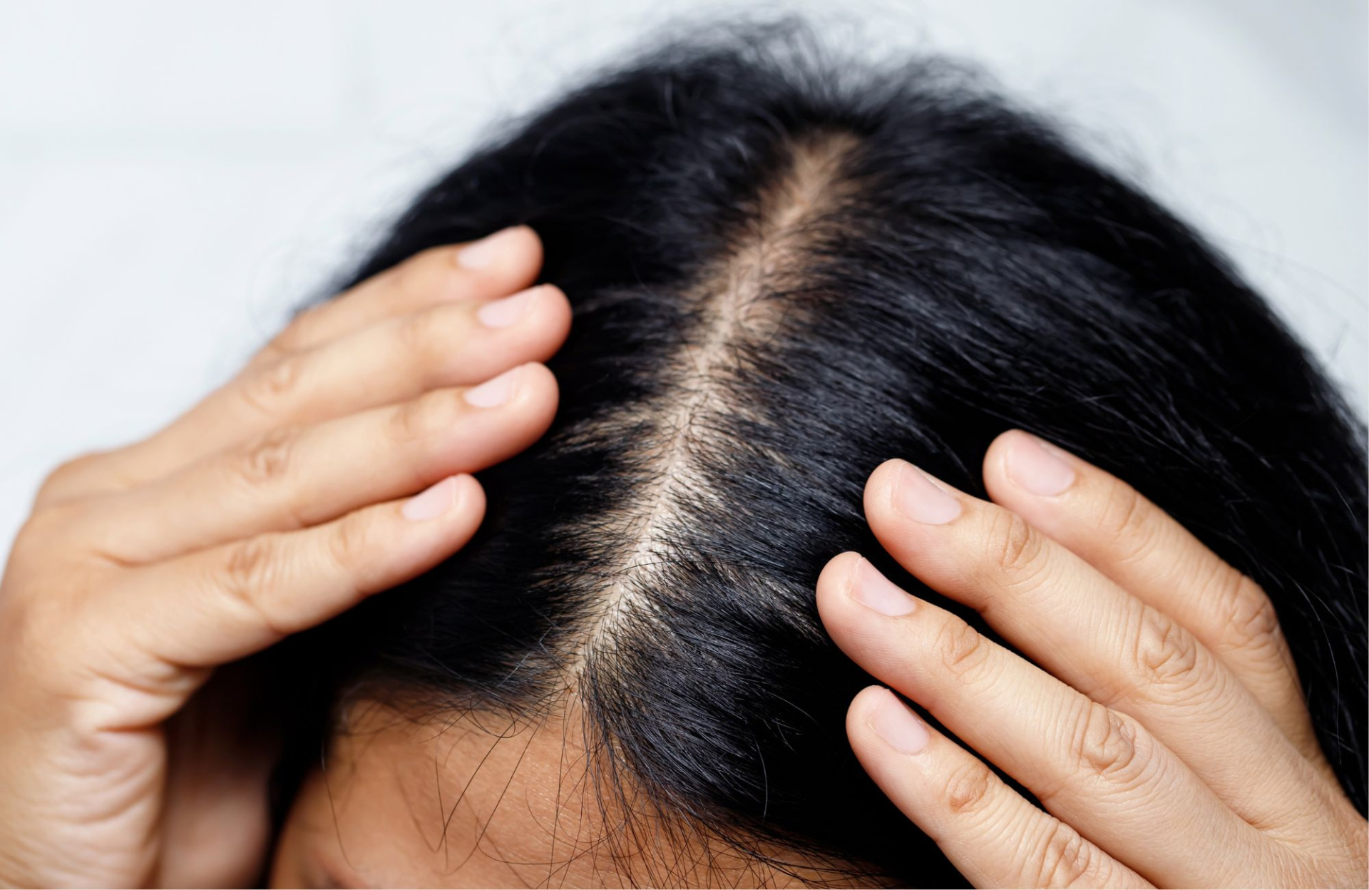 Андрогенетическая алопеция у женщин.jpg