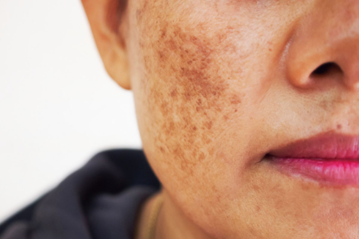 Пигментные пятна фото salon-mio.ru