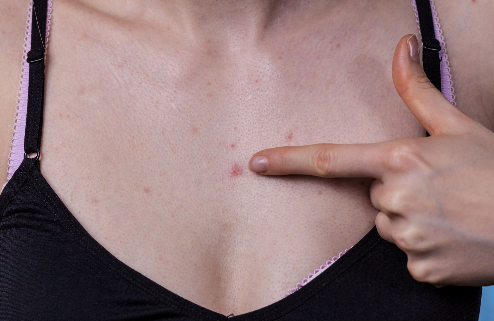 6-При заболеваниях и любых повреждениях кожи придется отказаться от тейпирования.jpg