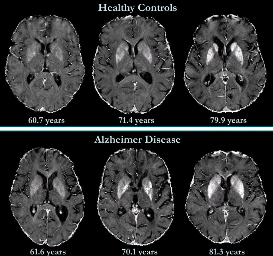 Альцгеймер мозг.jpg Альцгеймер мозг.jpg