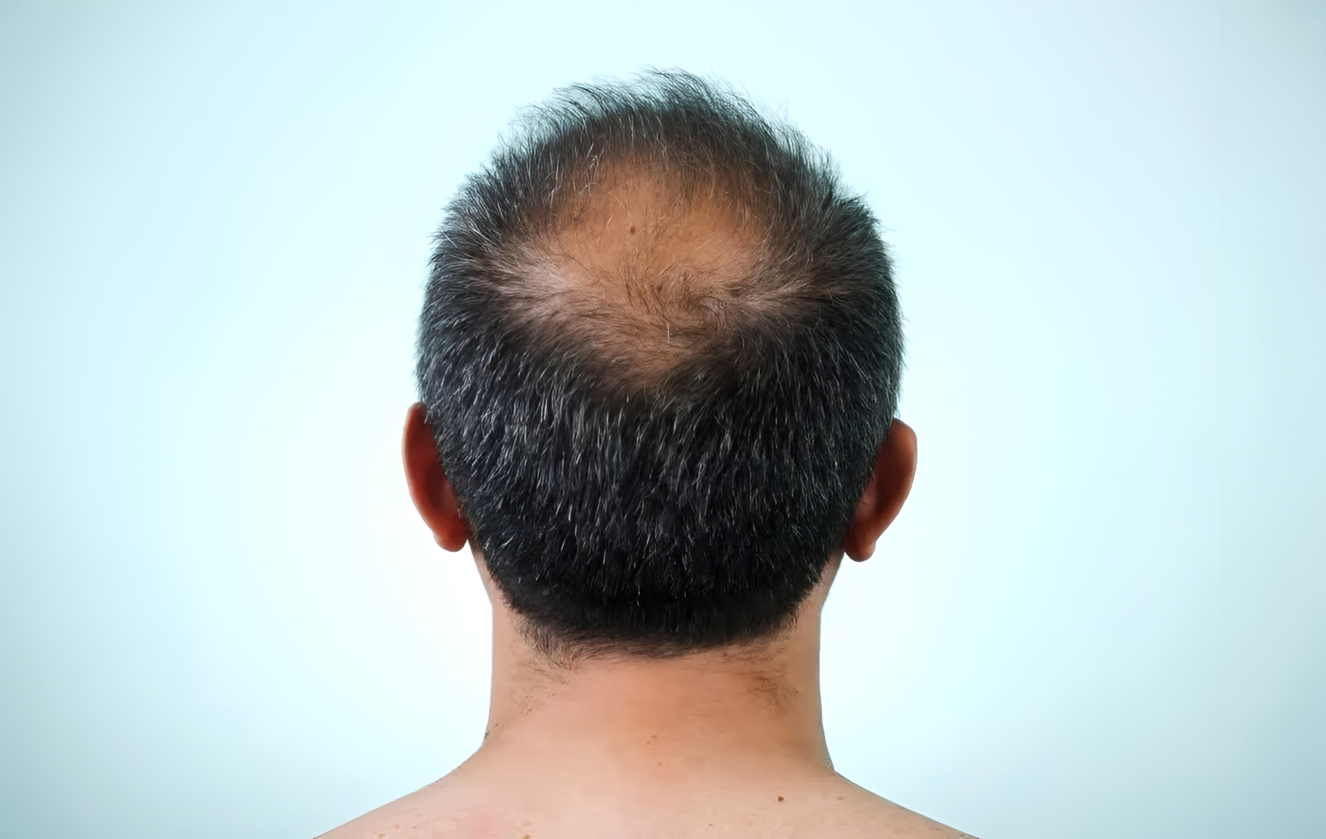 new_baldness_treatment_1_jpg (1).jpg