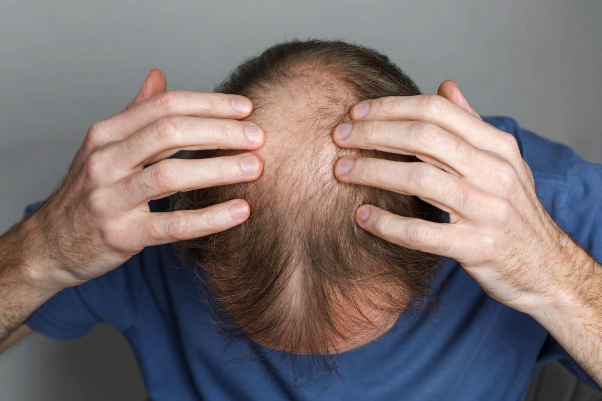 Mature-Balding-Man-Top-of-Head-Close-Up-1200x800.jpg