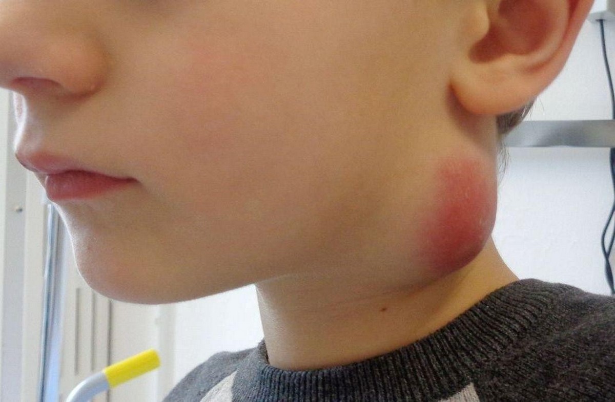 8-Воспаленный лимфоузел на шее бубон.jpg
