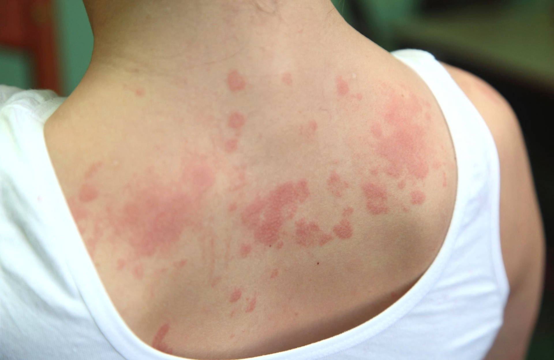 Аллергическая сыпь на спине.jpg