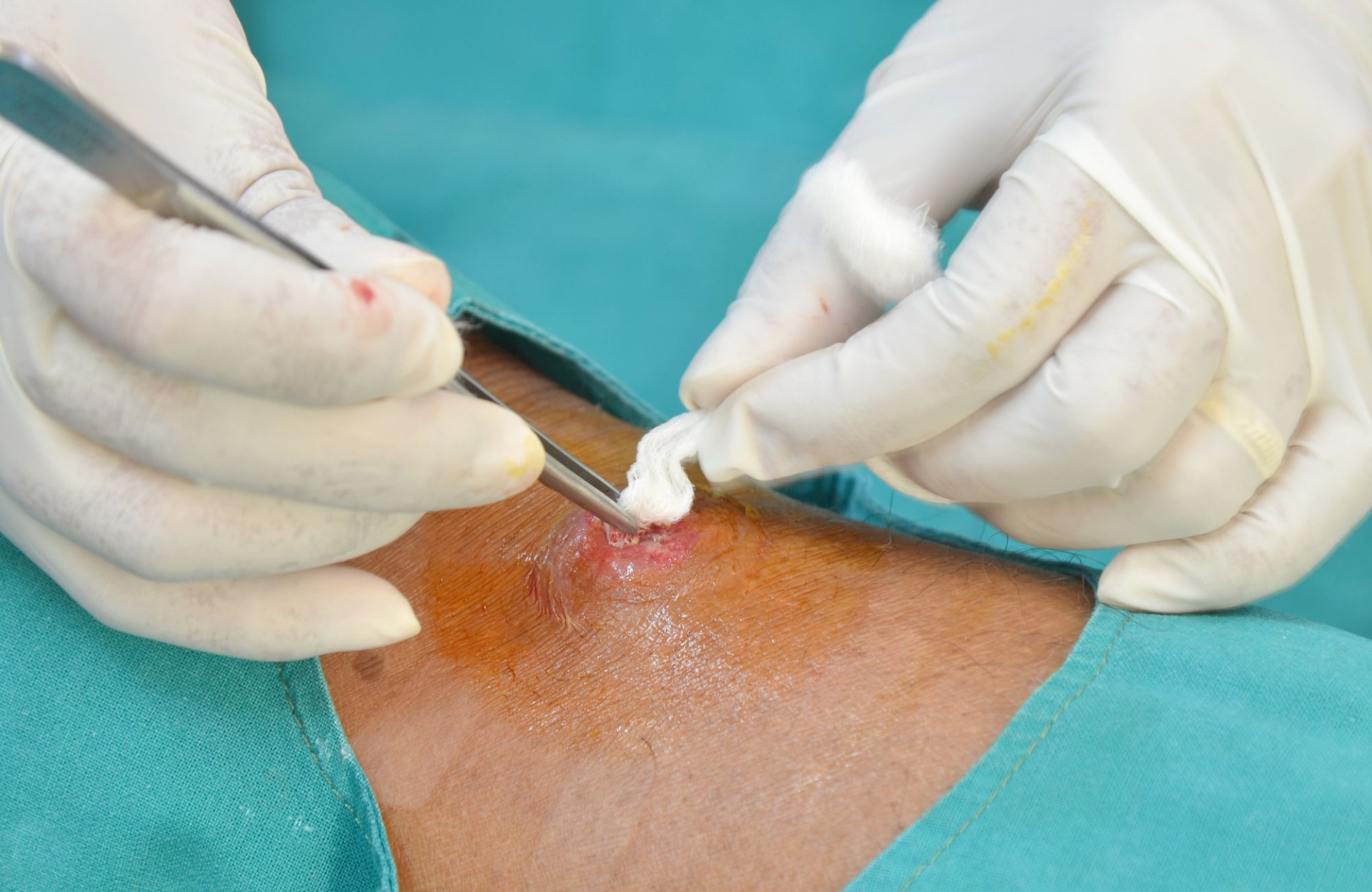 Хирургическое лечение ран.jpg