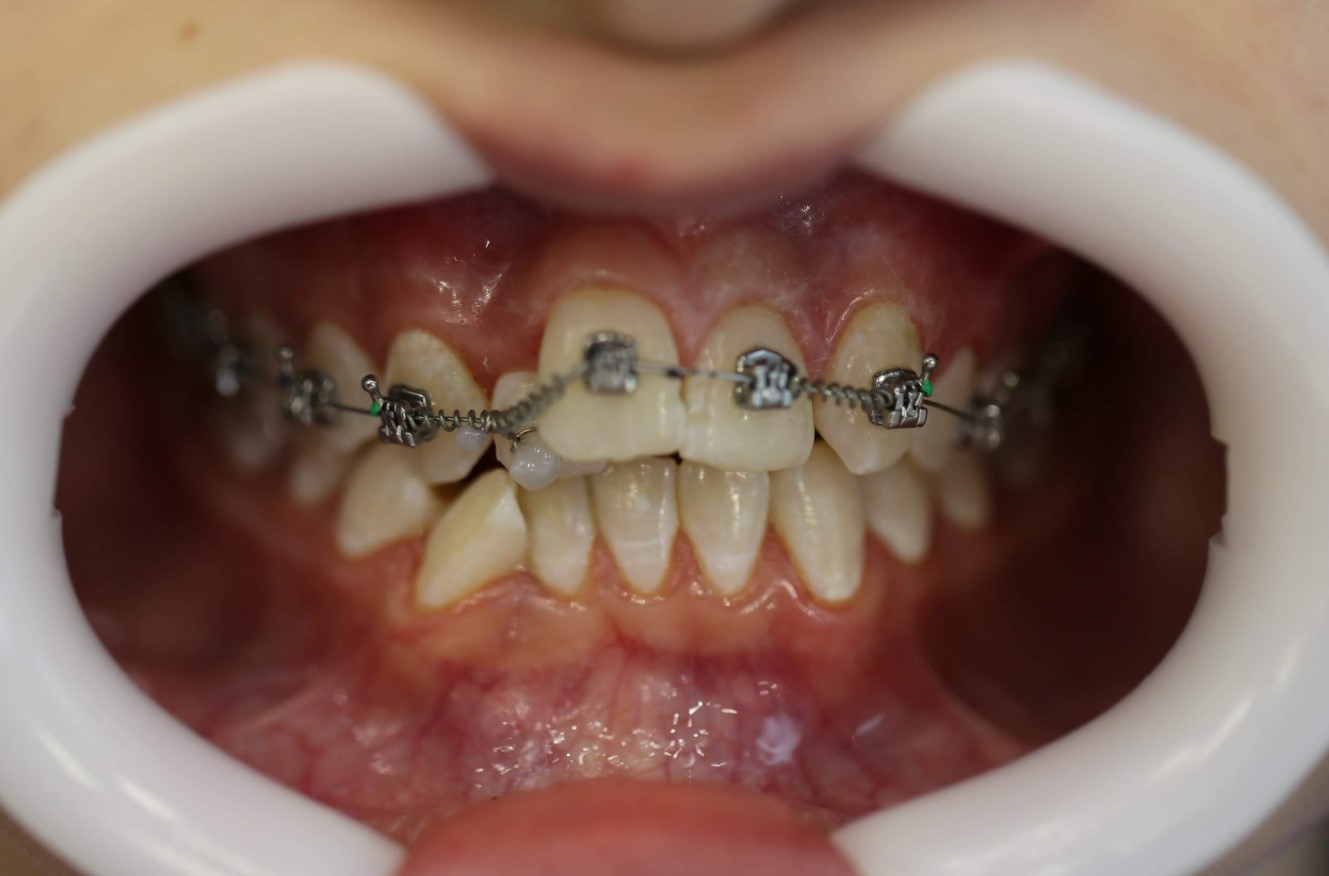 Зубы брекеты