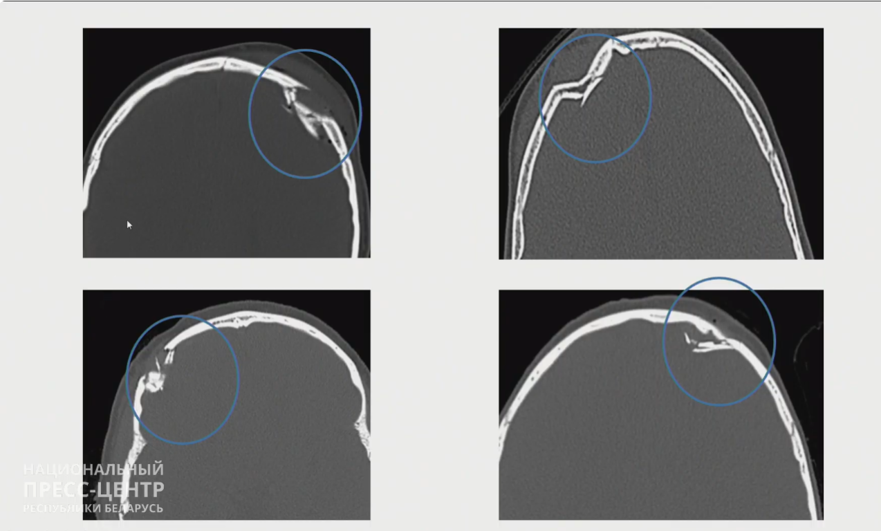 тюбинговые травмы