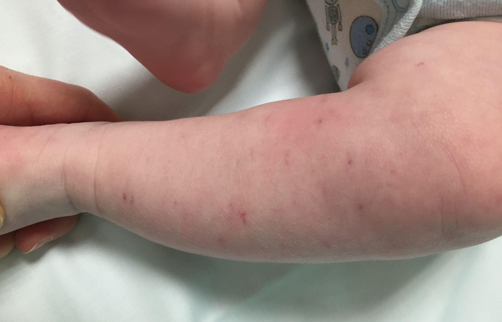 4-Сыпь при менингококковой инфекции.jpg