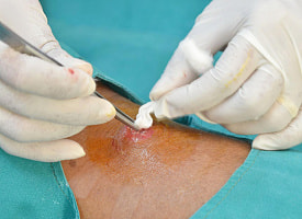 “Запечатывает рану за секунду”. В Южной Корее создали спрей против сильных кровотечений