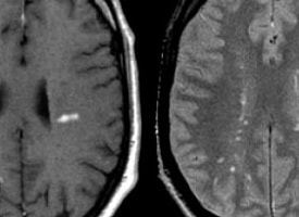 В Англии вспышка менингита привела к смертям молодых людей. Что важно знать о болезни?