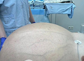 Удалили опухоль весом с человека: такого за 30 лет врачи еще не видели