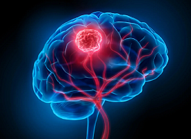 Рак мозга может начинаться за годы до выявления опухоли – новое исследование