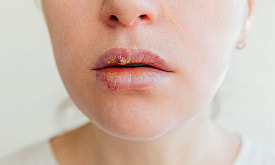 Без “пузырьков” на губе: можно ли распознать и остановить герпес до высыпаний? Рассказывает дерматолог