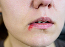 Может ли обычный герпес привести к некрозу сетчатки и энцефалиту? Узнали у врача