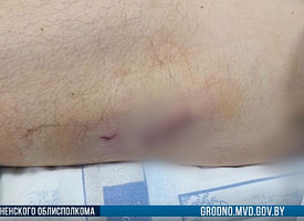 На Гродненщине с огнестрельными ранениями госпитализировали мужчину. МВД пообещало найти виновных