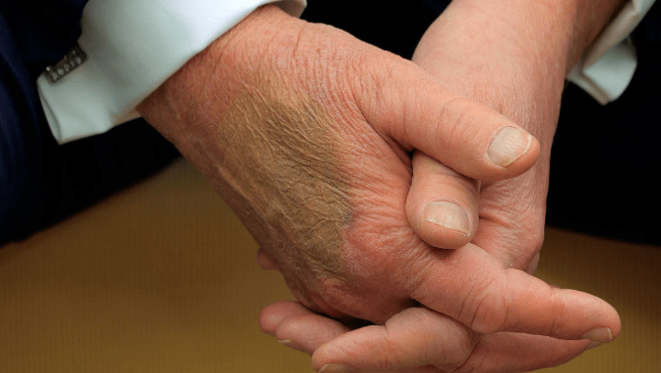 трамп синяк.png трамп синяк.png