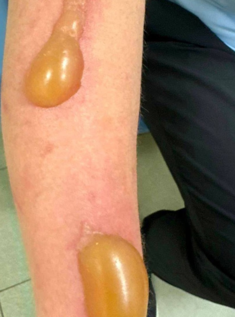 Борщевик ожоги 