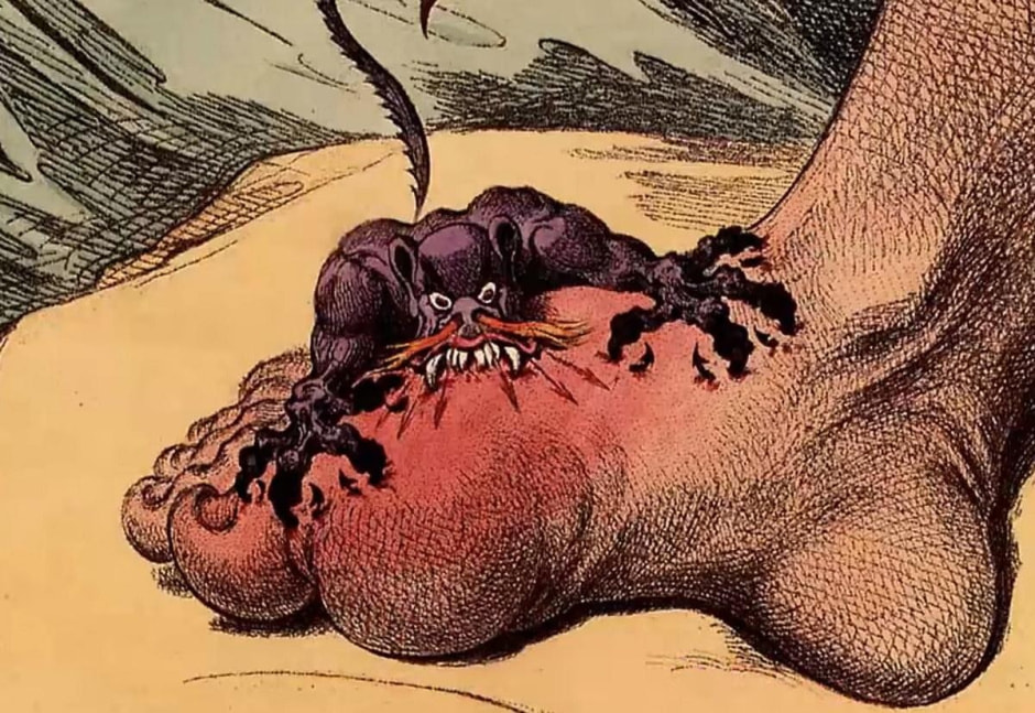 Подагра 1.jpg