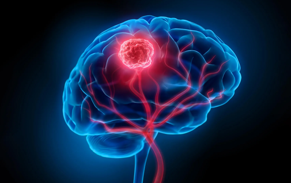 рак мозга