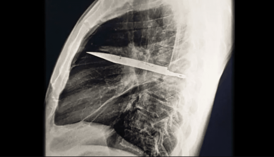 рентгеновский снимок ножа, застрявшего в груди мужчины