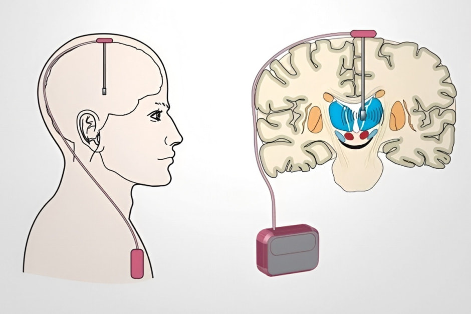 Глубокая стимуляция мозга