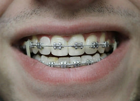 Почему людям понадобились брекеты – и при чём тут эволюция, мягкая еда и наши челюсти