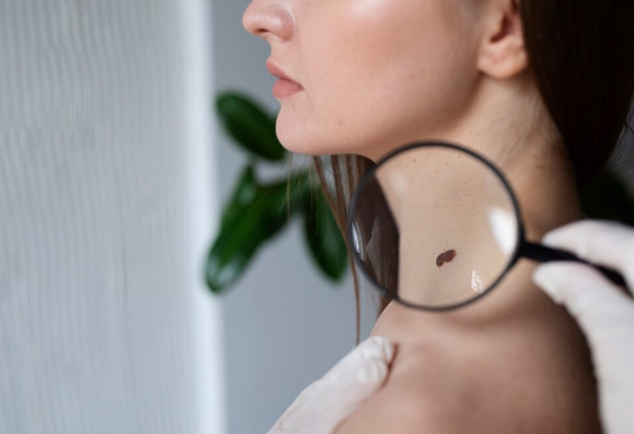 рак кожи.jpeg