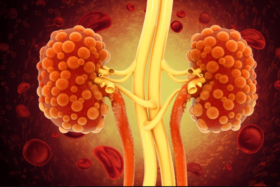 поликистоз почек