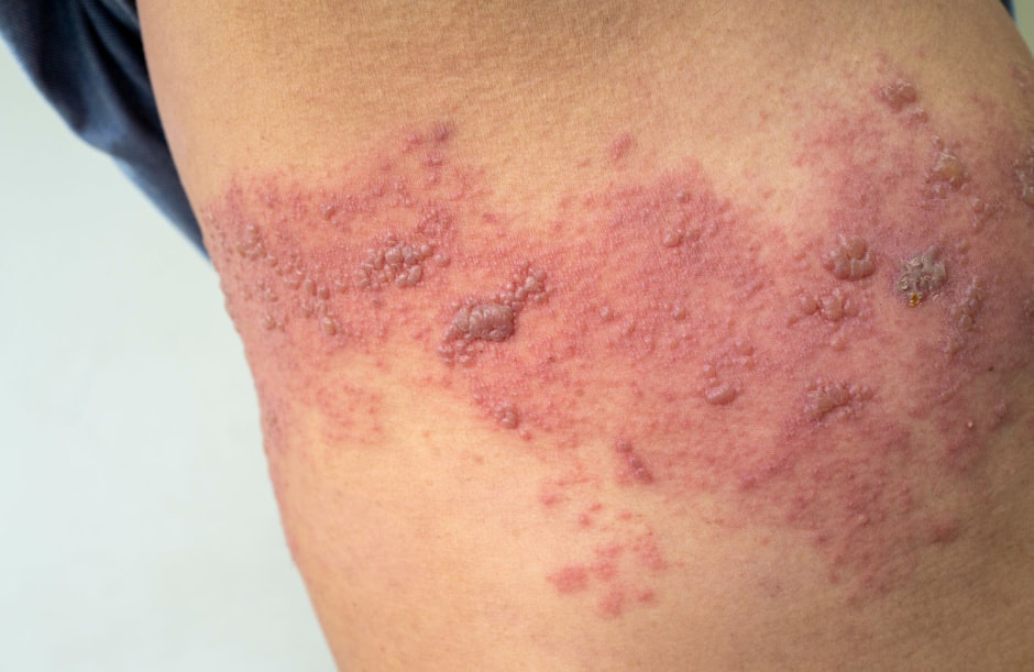 Ветрянка 4.jpg