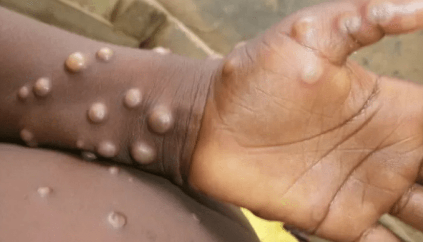 оспа.png оспа.png