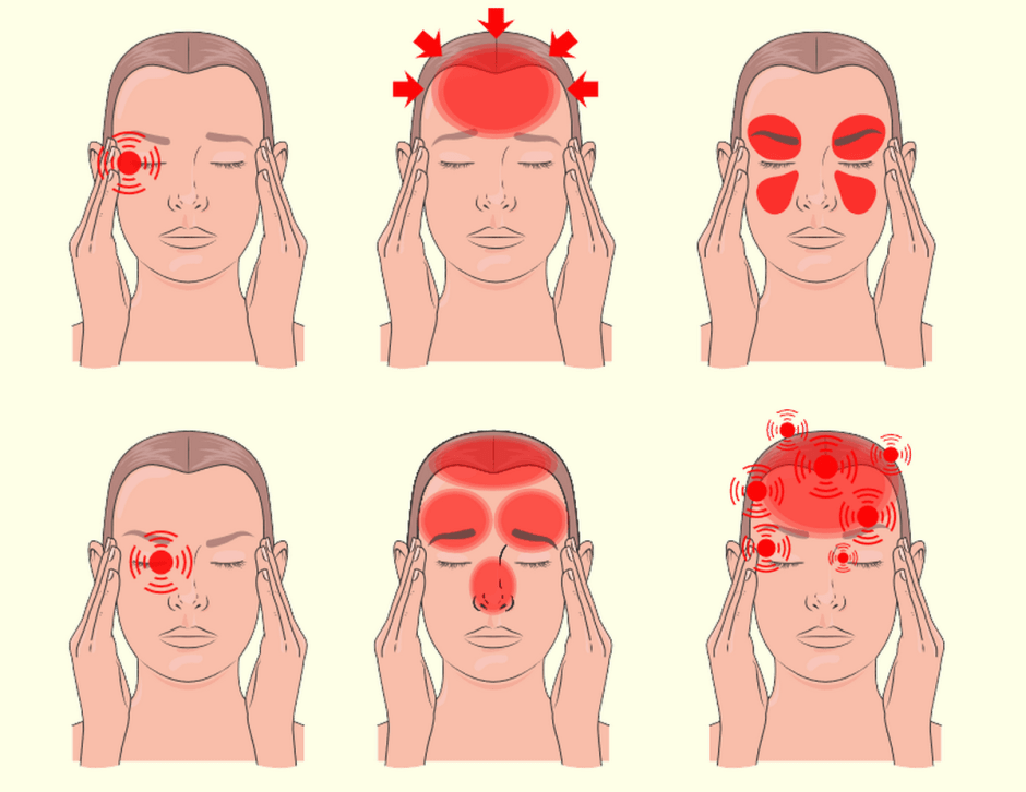 Как распознать мигрень 3.png