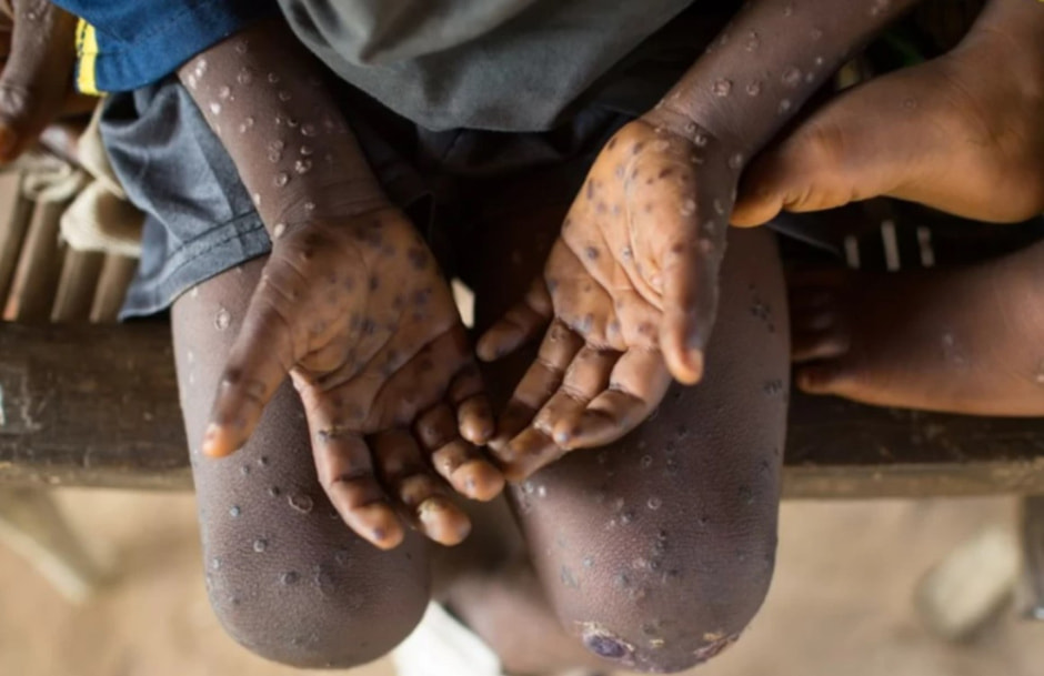 оспа обезьян .jpg