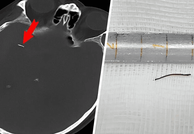 игла в голове.png