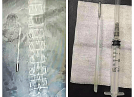 Мужчина 20 лет ходил с градусником в животе - предмет он проглотил еще в детстве