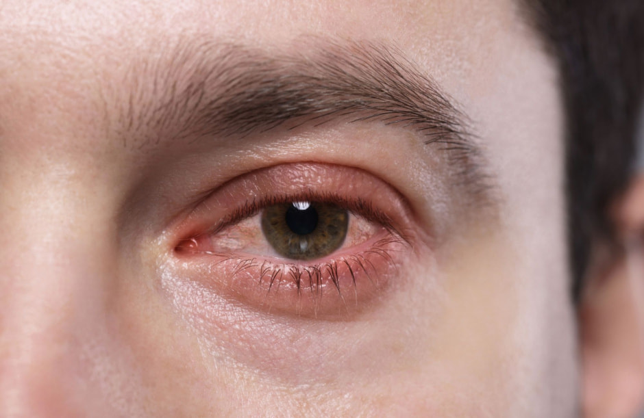 Аллергический конъюнктивит.jpg