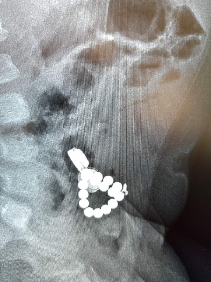 Ребенок проглотил магнит.jpg