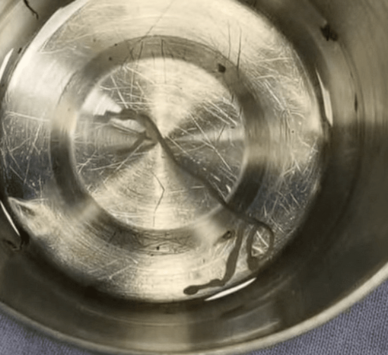 червь в мозге.png