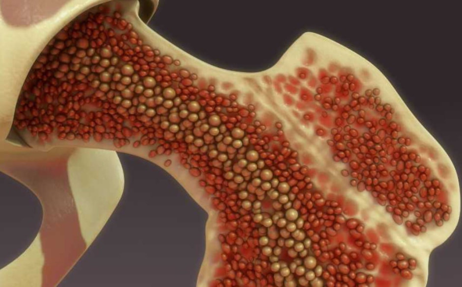 Миелонома Миелонома