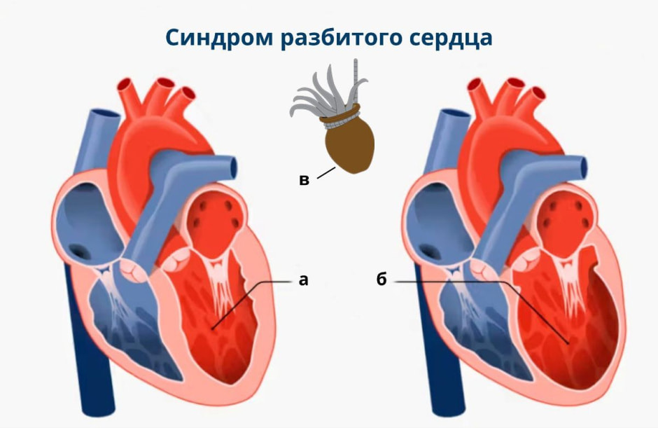 Синдром разбитого сердца 