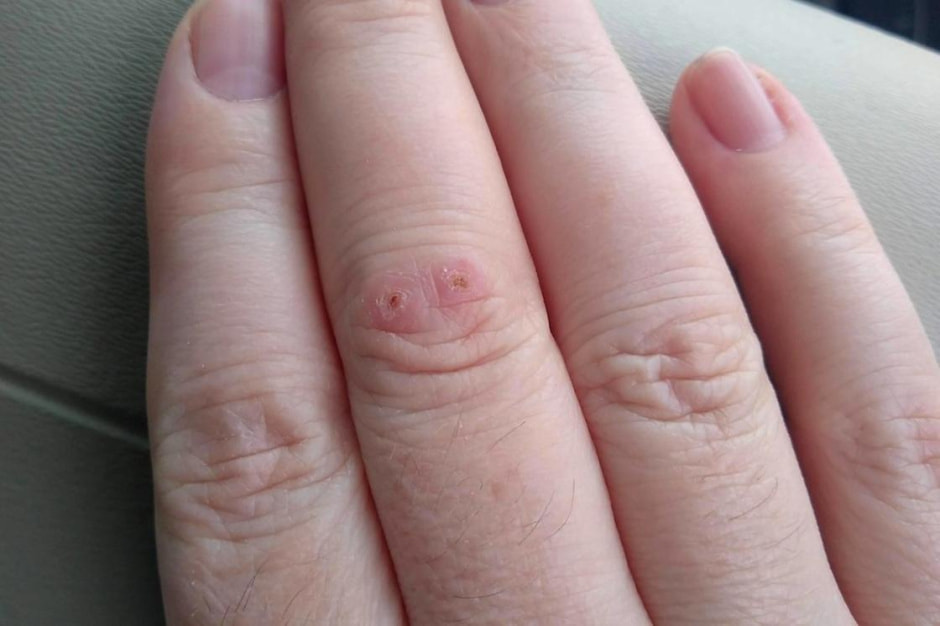 укус змеи.jpeg