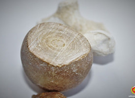 Почечный камень размером с мяч для пинг-понга извлекли у жителя Гродно