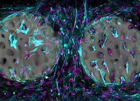 Металлические импланты останутся в прошлом? Ученые создали гидрогель, способный заменить их при переломах