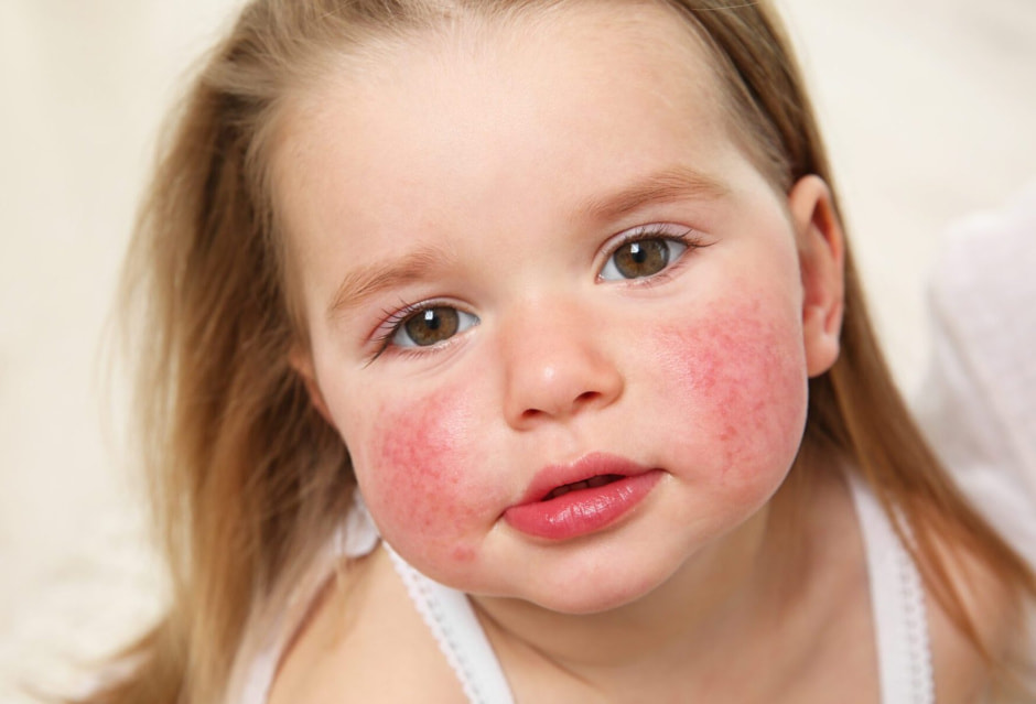 Псевдоаллергия на клубнику 2.jpg