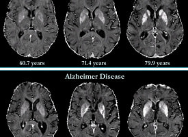 Тихий враг и новые союзники: как изменилась борьба с болезнью Альцгеймера за 100 лет