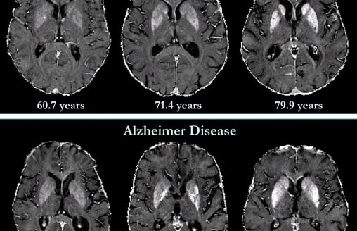 Тихий враг и новые союзники: как изменилась борьба с болезнью Альцгеймера за 100 лет