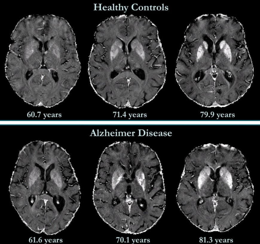 Альцгеймер мозг.jpg Альцгеймер мозг.jpg